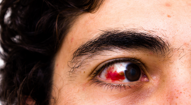 Understanding Personal Injury Lawyer’s Compensation for Eye Injuries in the UK