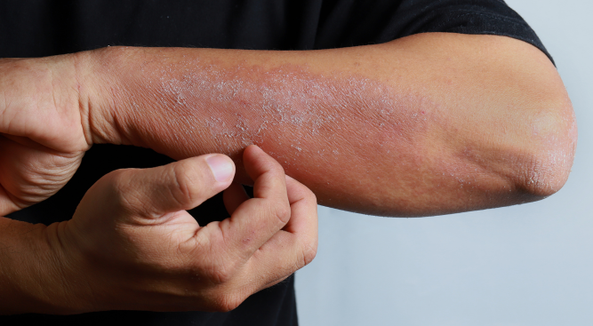 Personal Injury Lawyers and Occupational Dermatitis Claims UK