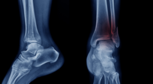 Personal Injury Lawyers Compensation for Stress Fractures UK