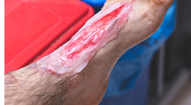 How Much Compensation for Burn Injury can I Claim in the UK -How to Claim Compensation in the UK